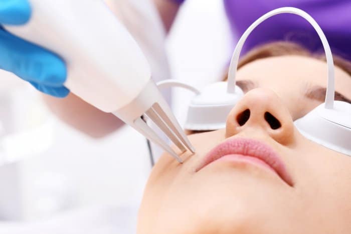 إزالة آثار حب الشباب القديمة