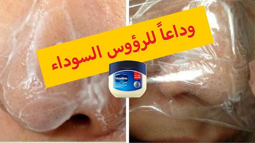ازالة الرؤوس السوداء من الانف