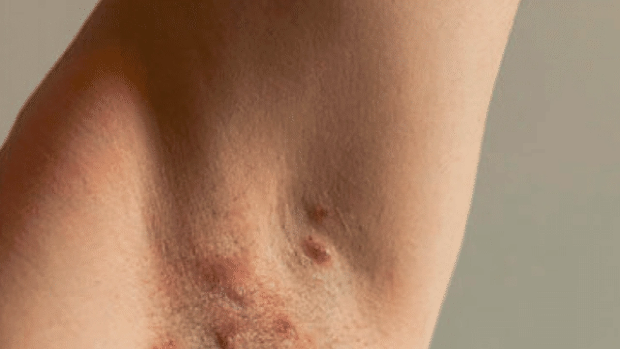 صورة ازالة ثالول الابط