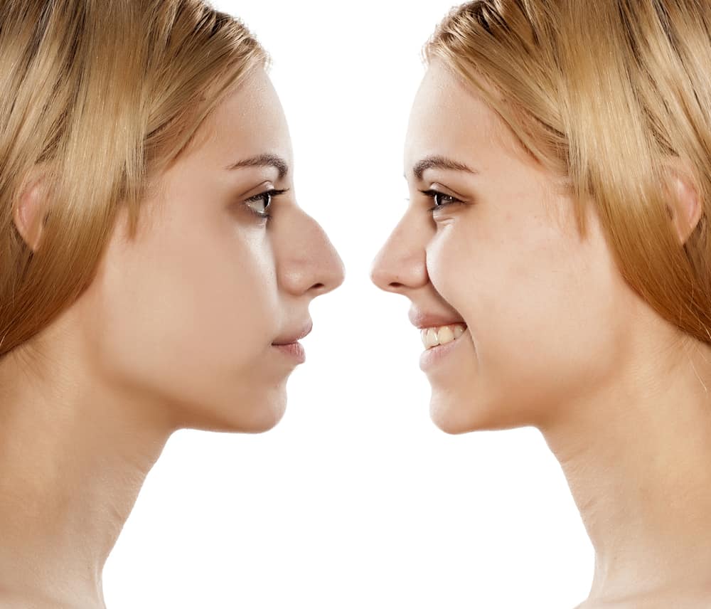 افضل دكتور تجميل انف بالمدينه المنوره