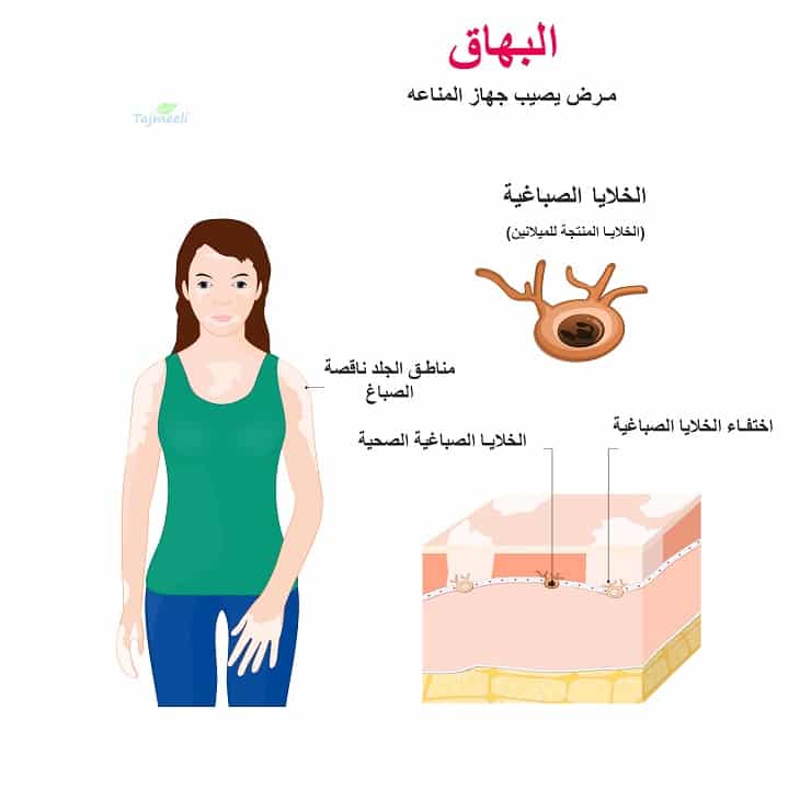 الفرق بين البهاق والفطريات بالصور