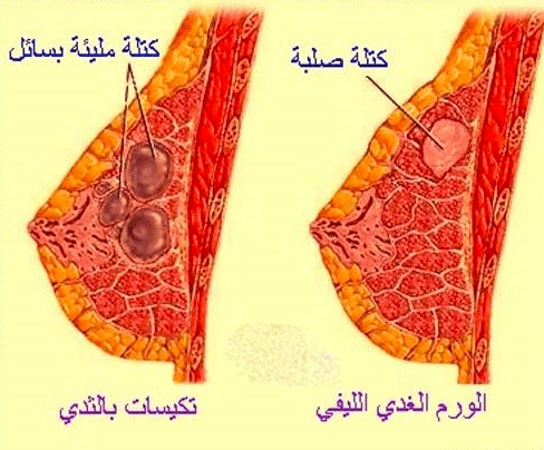 تجاربكم مع اكياس الثدي عالم حواء