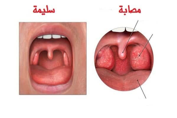 تجاربكم مع التهاب الحلق عند الأطفال