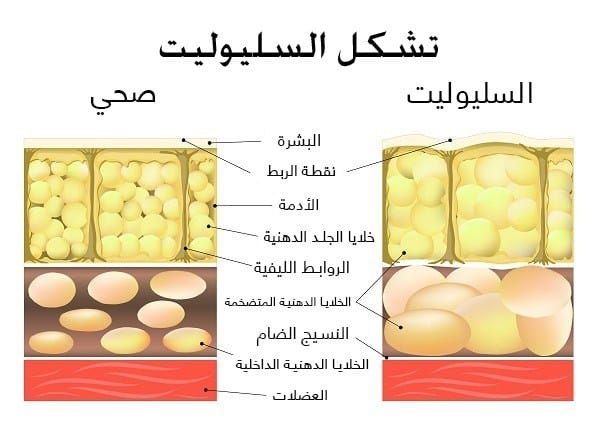 تجاربكم مع السيلوليت