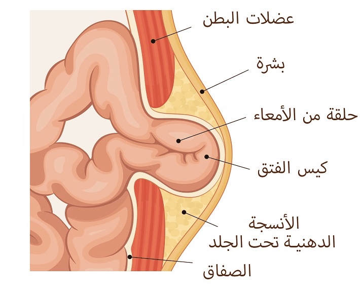 تجاربكم مع الفتق
