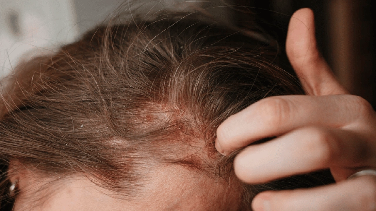 صورة تجاربكم مع فطريات الشعر للاطفال