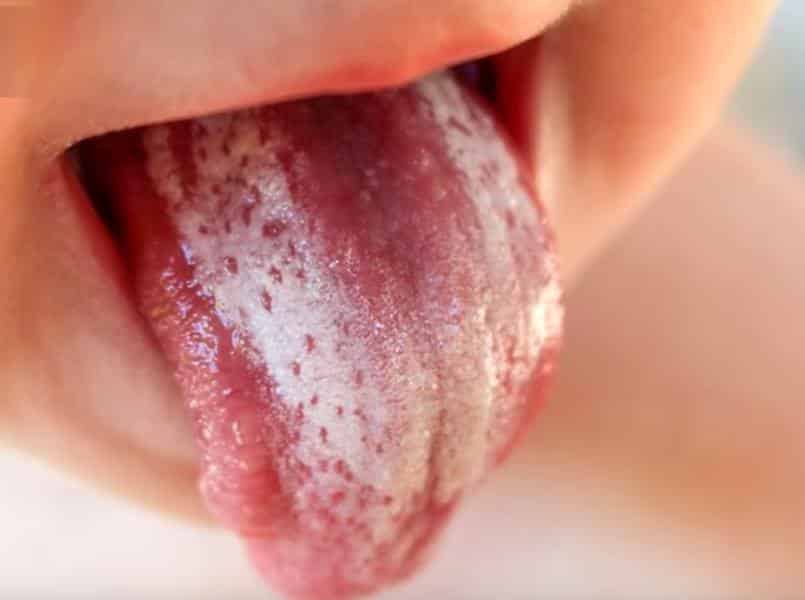 تجاربكم مع فطريات الفم