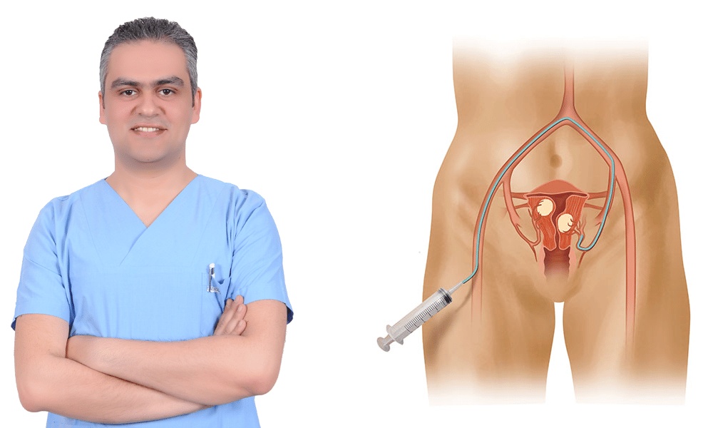 تجاربكم مع قسطرة الرحم