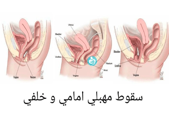 تجاربكم مع هبوط المثانة