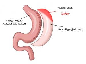 تجربتي بعد شهرين من التكميم