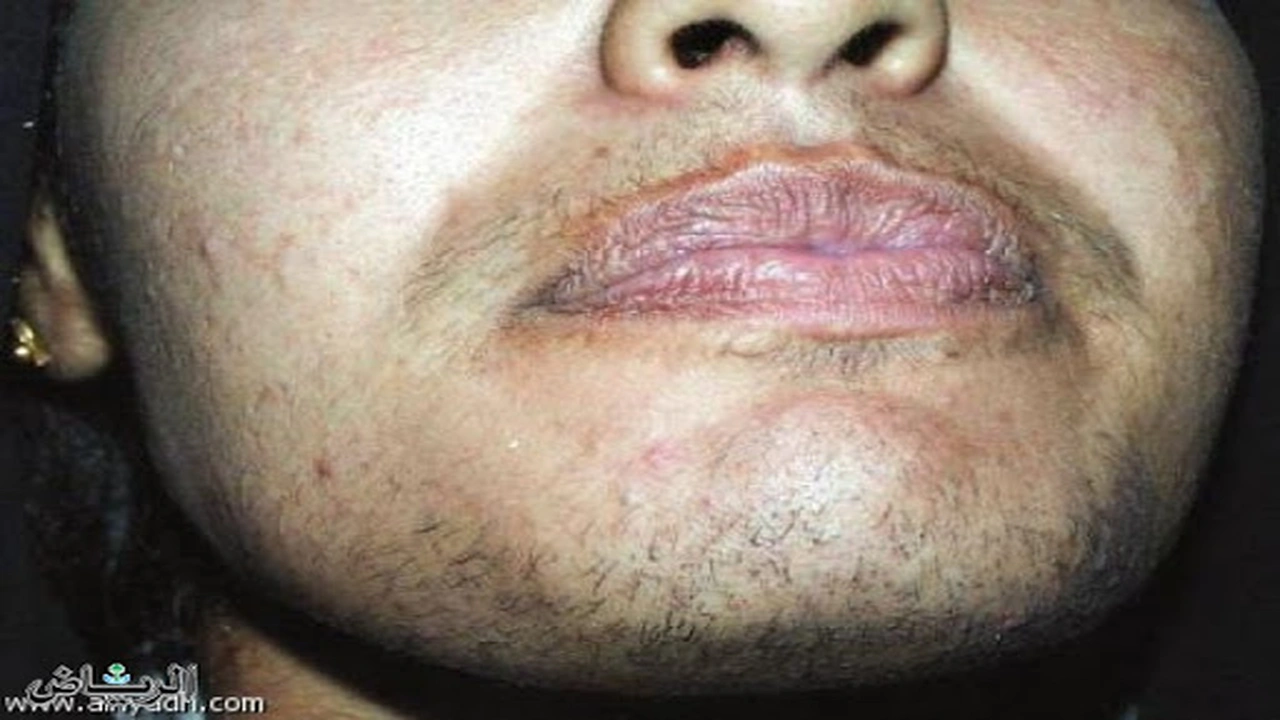 صورة تجربتي في التخلص من الشعرانية