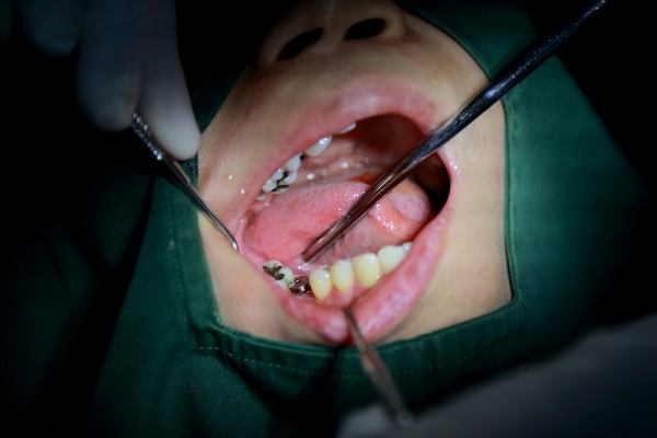 تجربتي في زراعة الأسنان في تركيا