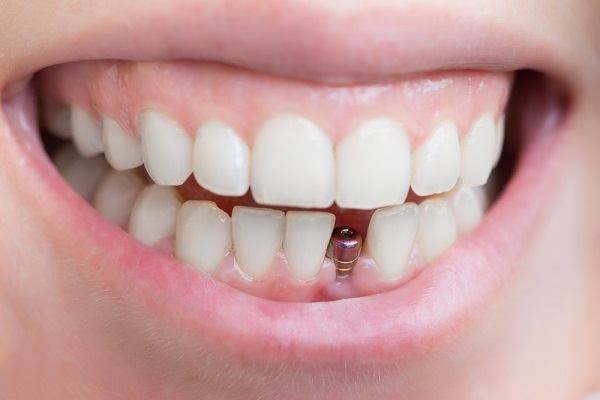 تجربتي في زراعة الأسنان في تركيا
