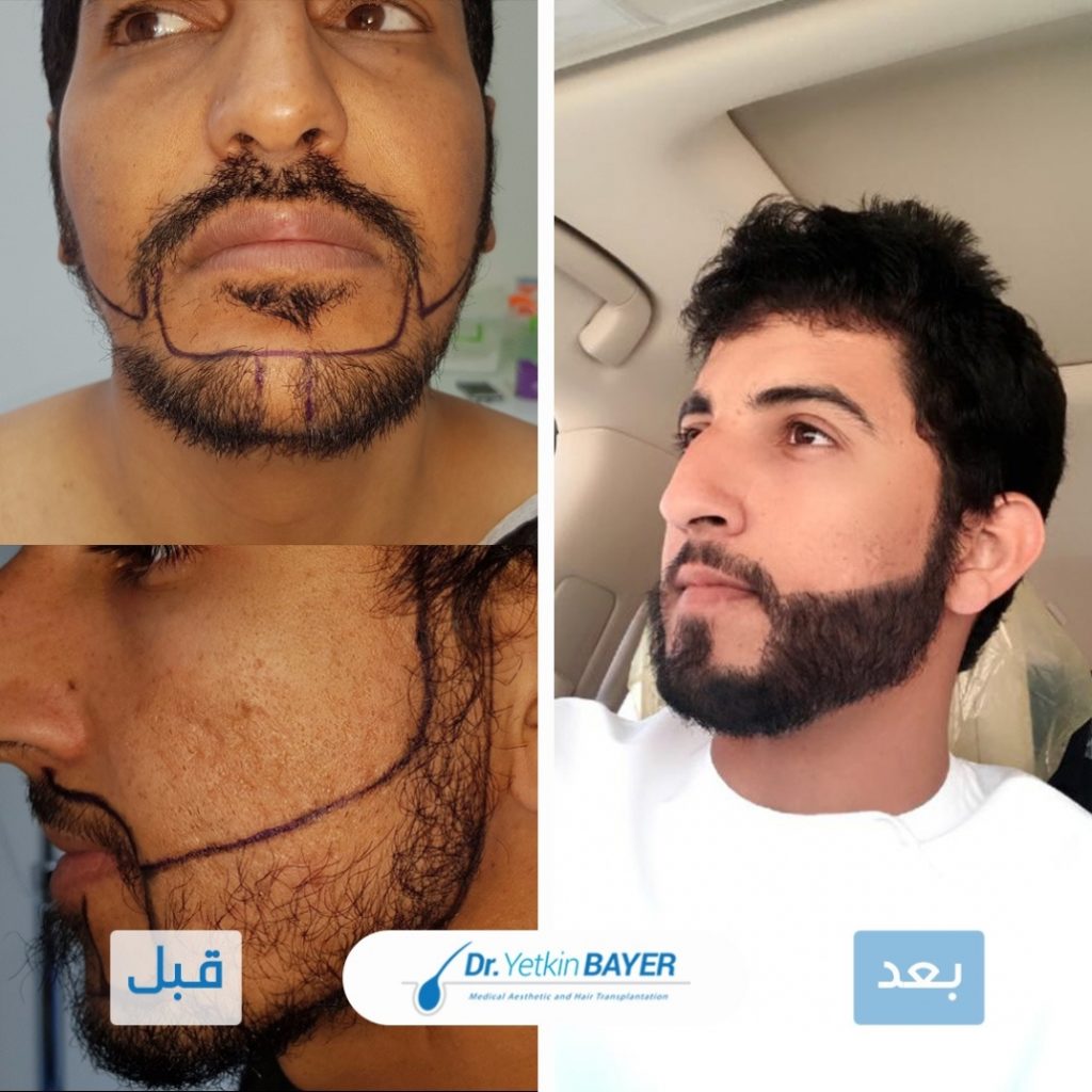 تجربتي في زراعة الذقن