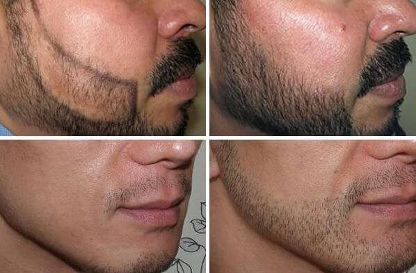 تجربتي في زراعة الذقن