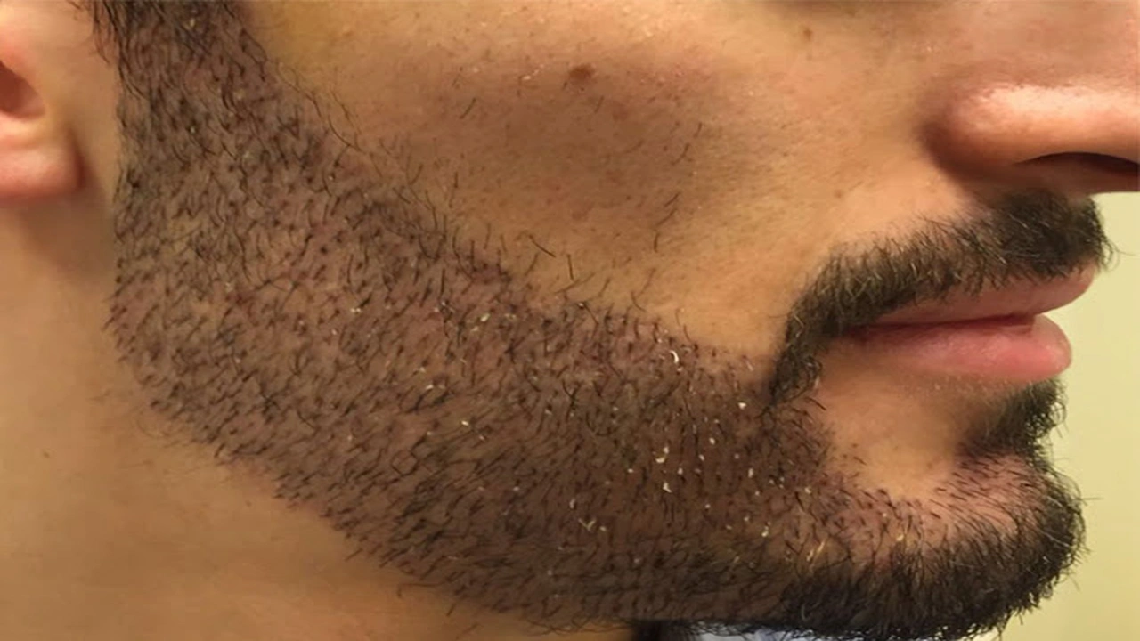 صورة تجربتي في زراعة الذقن