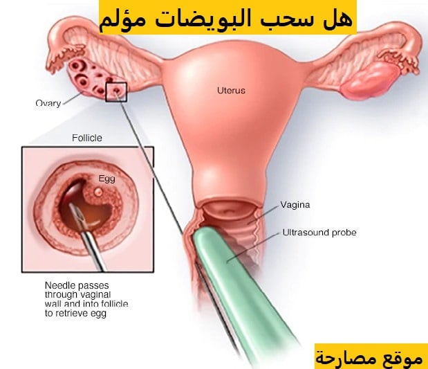تجربتي في سحب البويضات