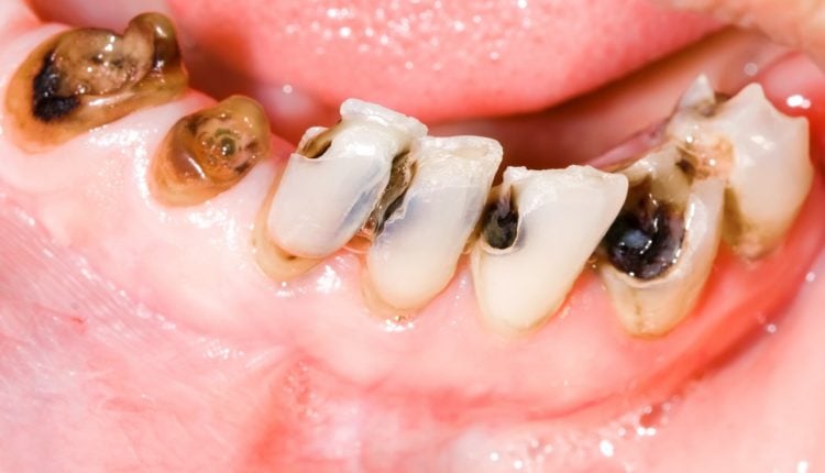 تجربتي في علاج التسوس