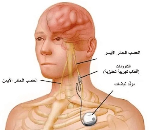 تجربتي مع العصب الحائر