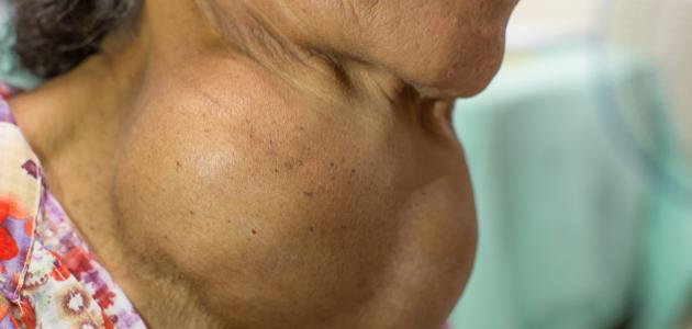 تجربتي مع الغدة الدرقية