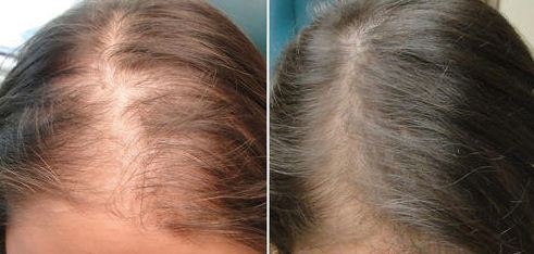 تجربتي مع الميزوثيرابي للشعر