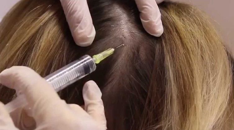 تجربتي مع الميزوثيرابي للشعر