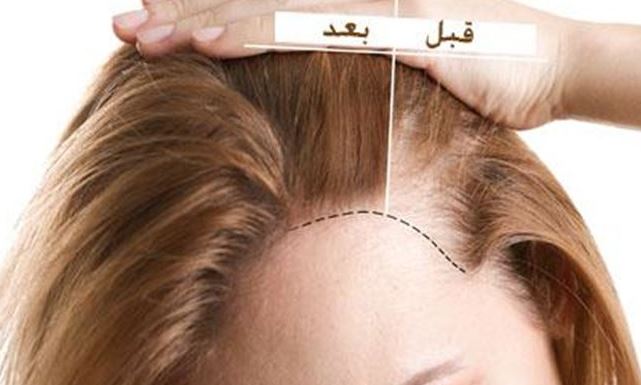 تجربتي مع امبولات الخلايا الجذعية للشعر