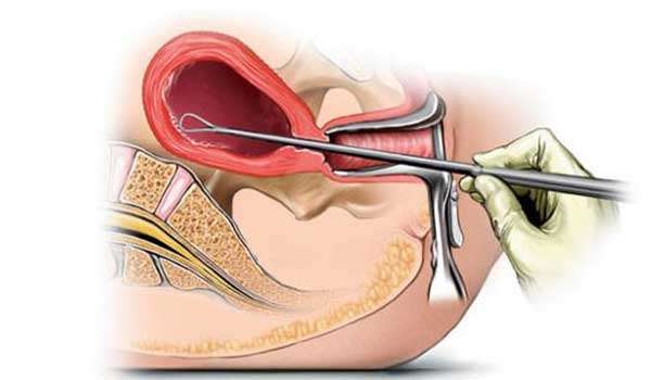 تجربتي مع بقايا الاجهاض