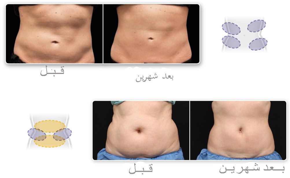 تجربتي مع جهاز تفتيت الدهون