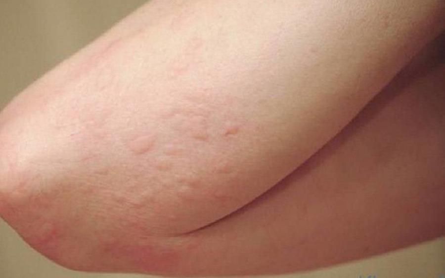 تجربتي مع حساسية الجلوتين