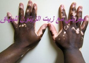 تجربتي مع زيت الزيتون للبهاق