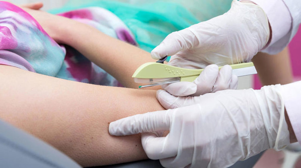 تجربتي مع شريحة منع الحمل