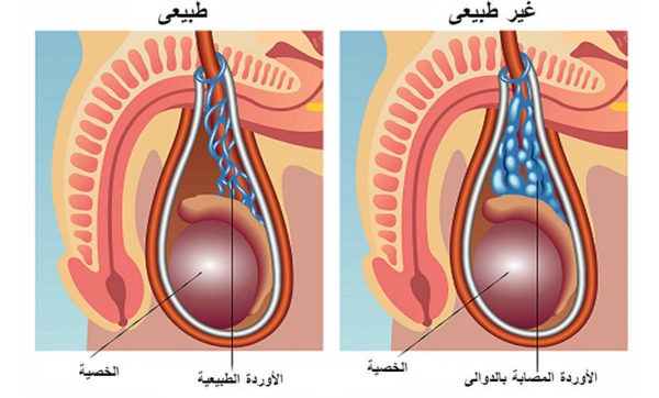 تجربتي مع ضمور الخصية