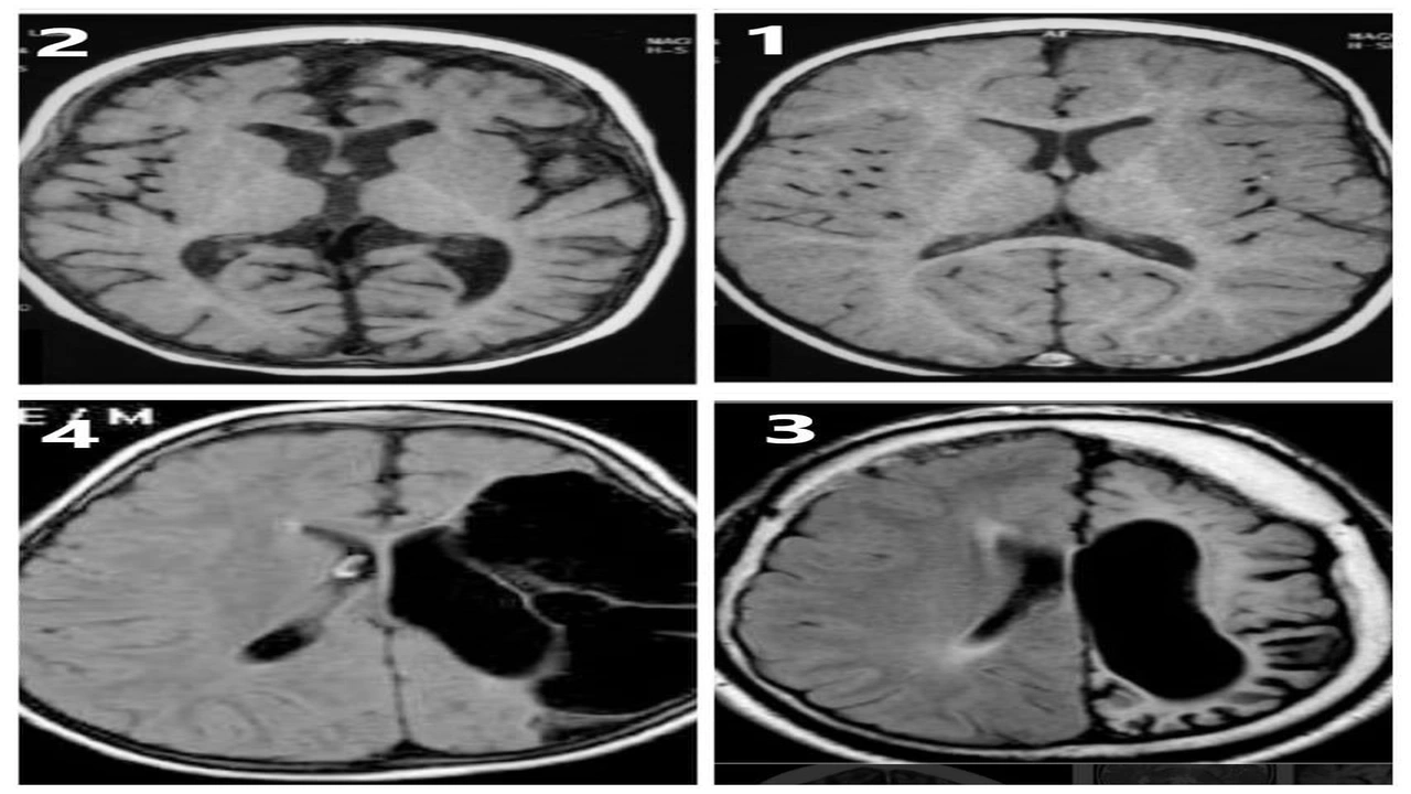 صورة تجربتي مع ضمور المخ