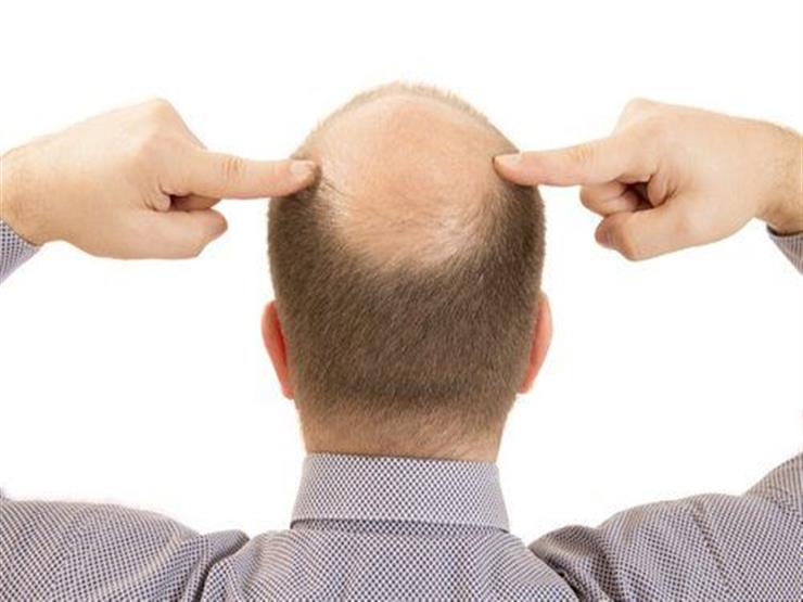 تجربتي مع علاج الصلع الوراثي