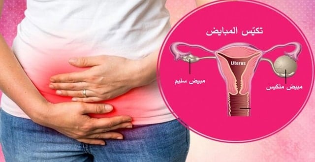 تجربتي مع علاج تكيس المبايض