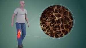 تجربتي مع علاج هشاشة العظام