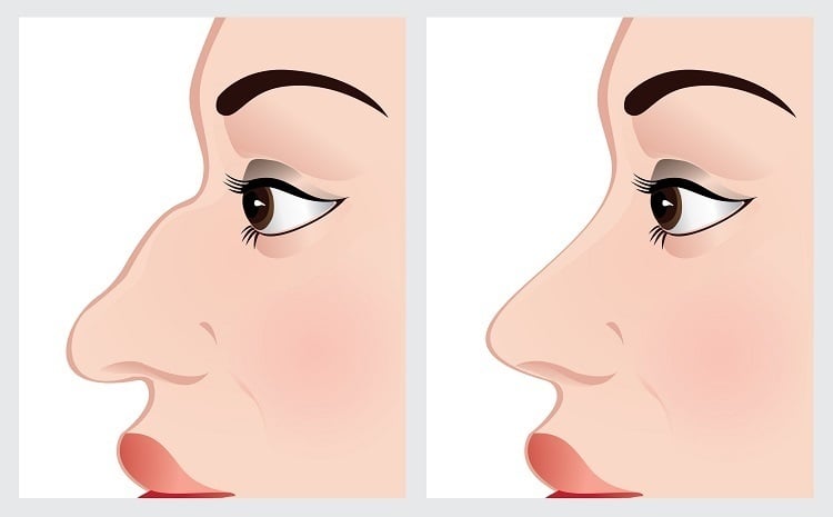 تجربتي مع عملية تجميل الانف