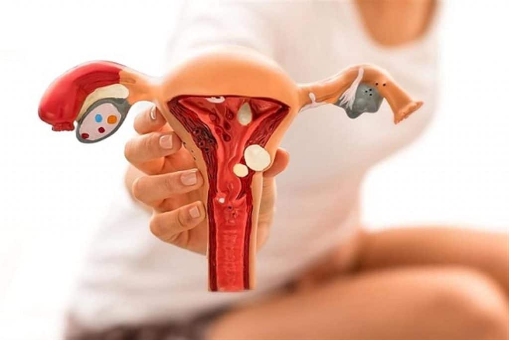 تجربتي مع لحمية الرحم