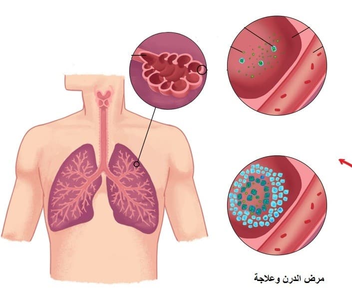 تجربتي مع مرض الدرن