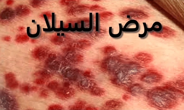 تجربتي مع مرض السيلان