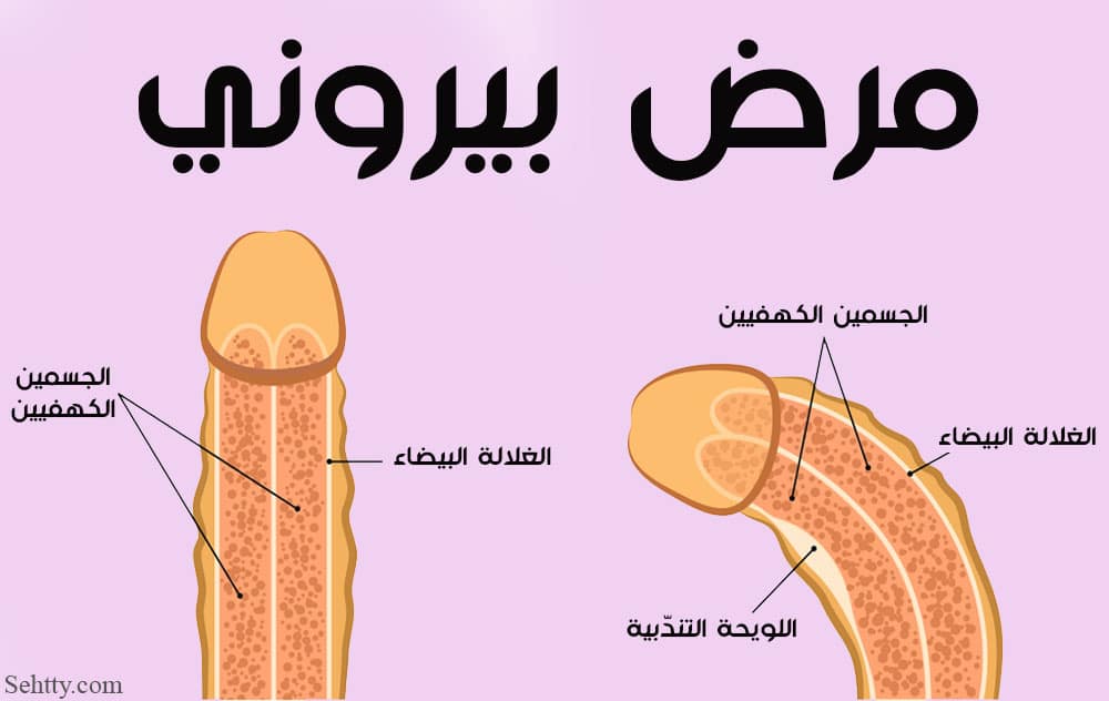 تجربتي مع مرض بيروني