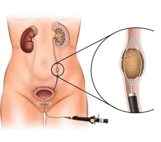 تجربتي مع منظار الحالب