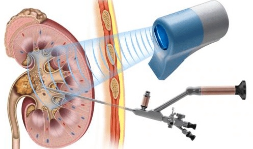تجربتي مع منظار الحالب