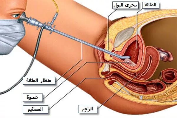 تجربتي مع منظار المثانة