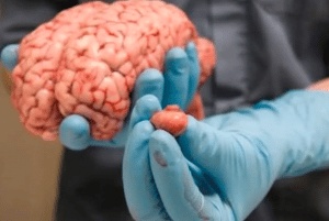 تجربتي مع نزيف الدماغ