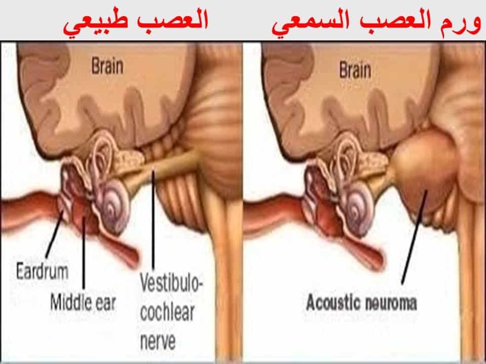 تجربتي مع ورم العصب السمعي