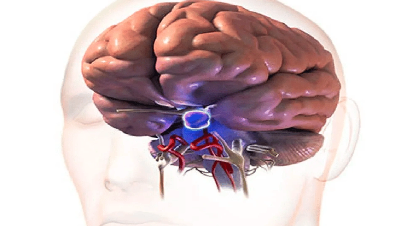 صورة تجربتي مع ورم الغدة النخامية