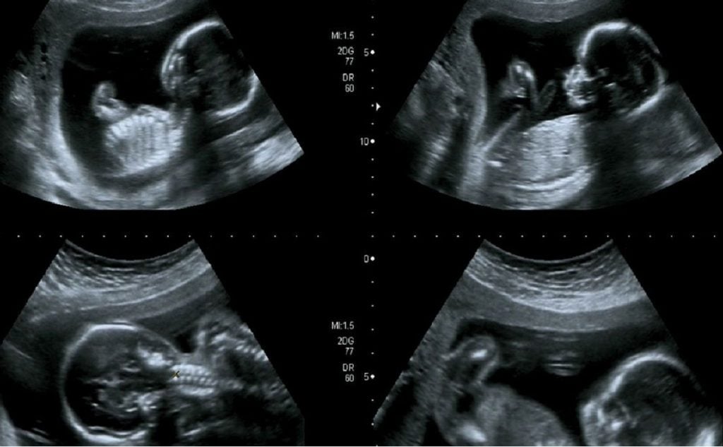 تحديد جنس الجنين