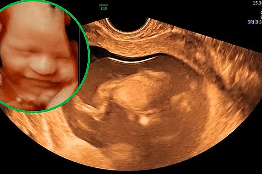 تحديد جنس الجنين